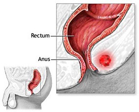 Peri anal abscess